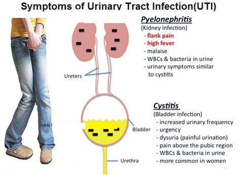 sore uei|Urinary tract infection (UTI)